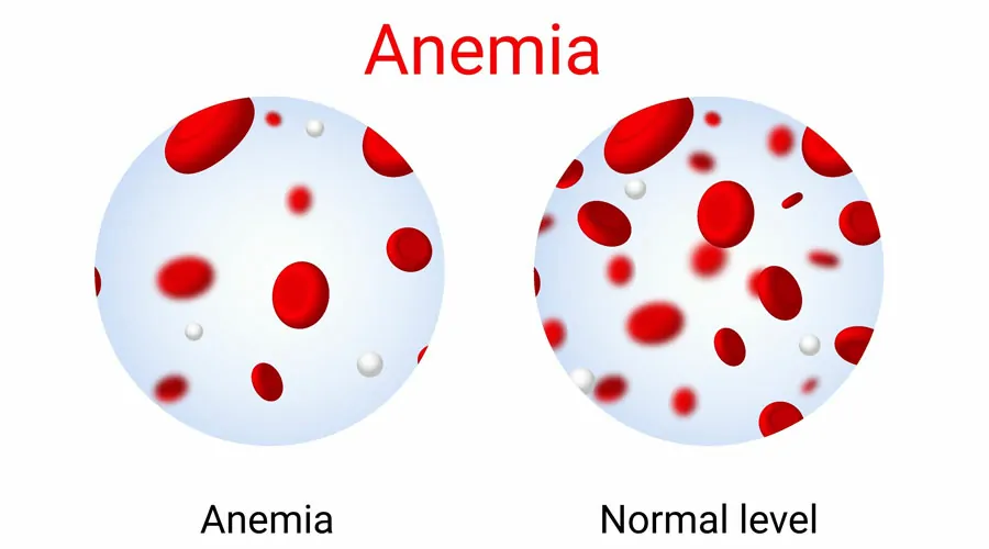 Anemia Profile